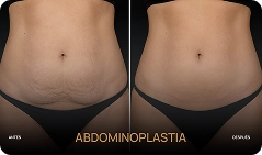 yuda a restaurar la forma, simetría y volumen de las cejas con un resultado natural y personalizado.