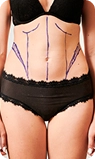 abdominoplastia