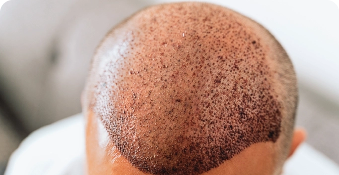 implante-de-pelo
