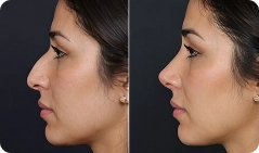 rinoplastia 1