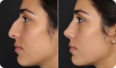 rinoplastia 2